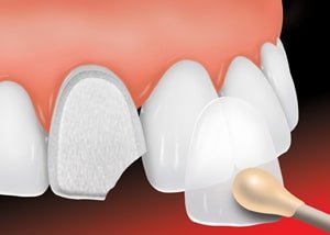 Professional Dental & Orthodontics - ADA Dental Veneer 1 new