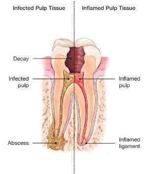 Professional Dental & Orthodontics - abscessed tooth
