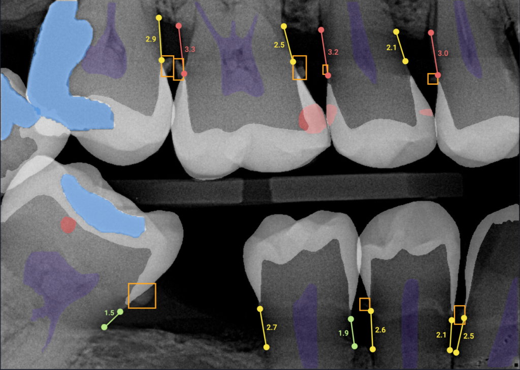 Dental exam using artificial intelligence technology for accurate diagnostics at Professional Dental