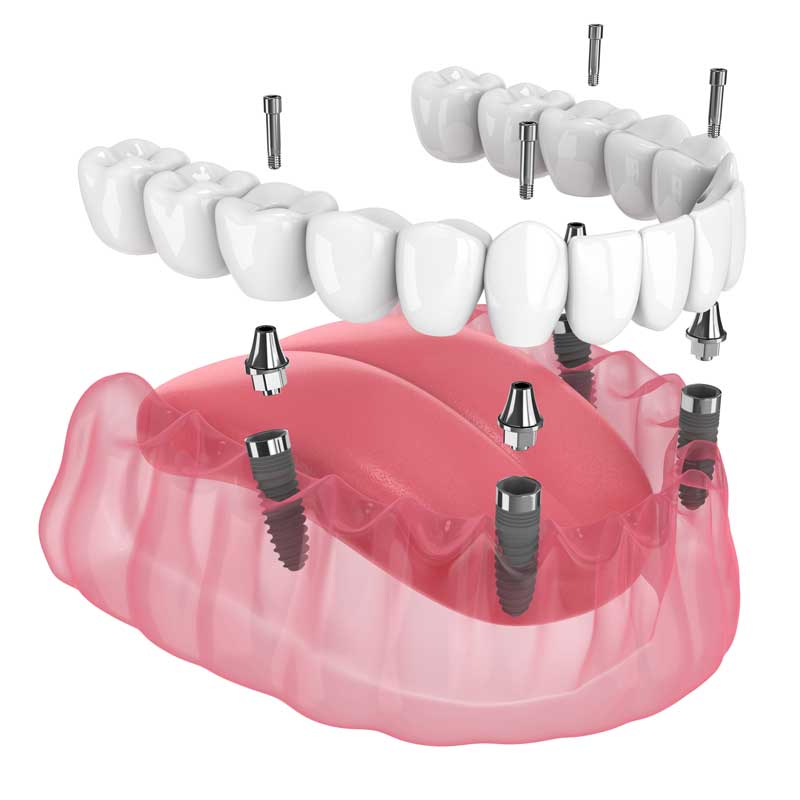 All on 4 Dental Implants - Professional Dental