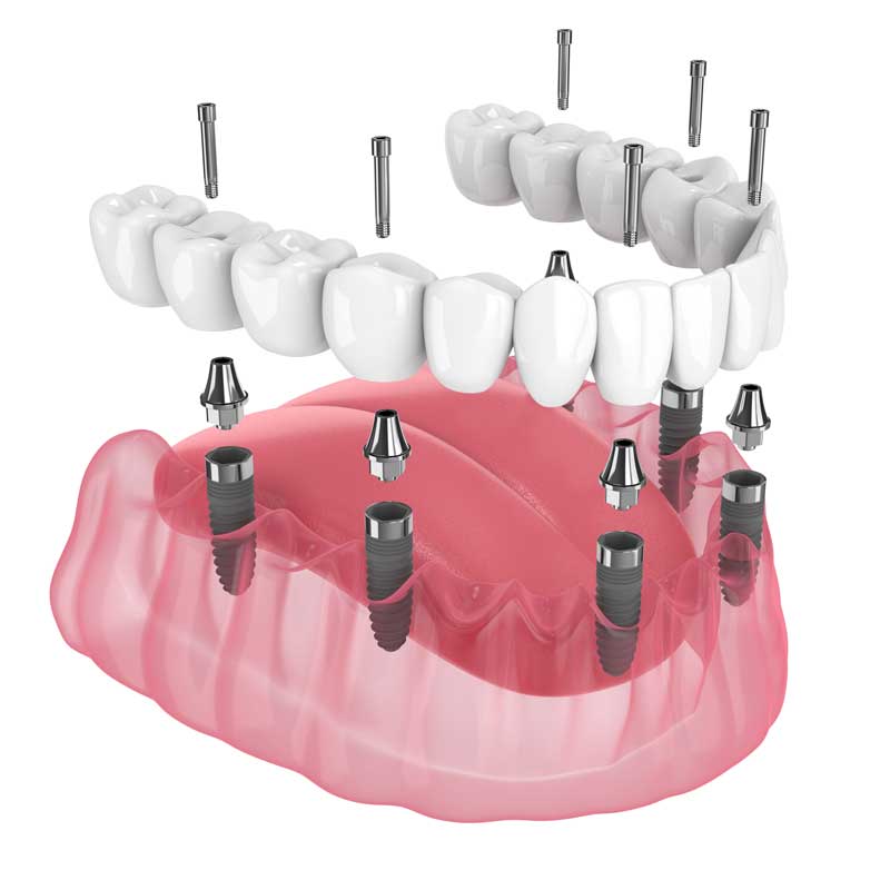 All on 6 Dental Implants Atlanta - Professional Dental