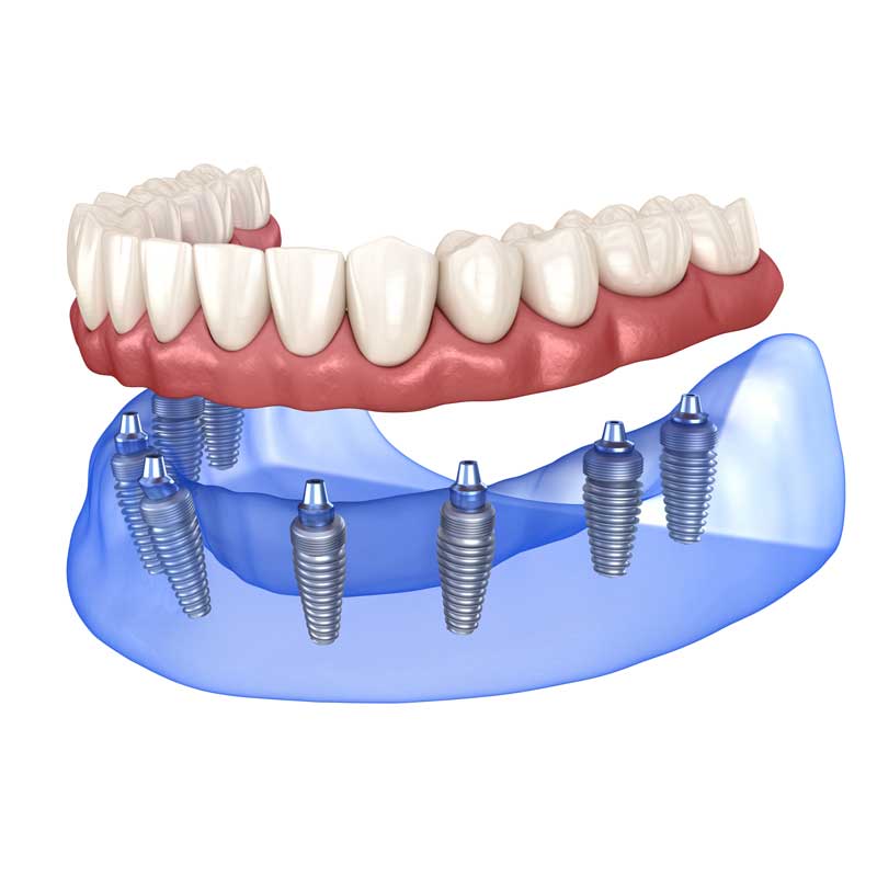 Fixed Full Arch Implants - Professional Dental