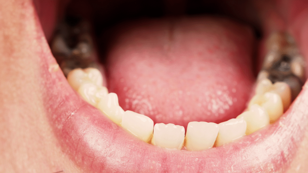 Caries Risk Assessment and Tooth Decay Prevention 1 - Professional Dental Caries risk assessment and tooth decay prevention exam.