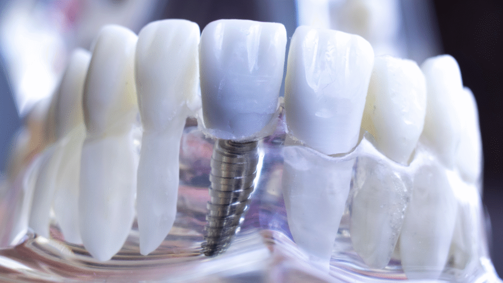 Your Path to a Permanent Smile: Why Dental Implants at Professional Dental are the Smartest Investment 1 - Professional Dental Close-up of a single dental implant.