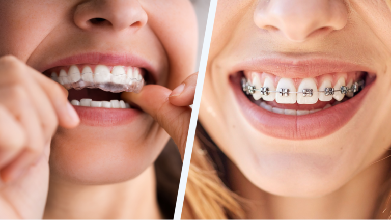 Side-by-side comparison infographic detailing features like visibility, removability, and hygiene for braces versus clear aligners at Professional Dental in Utah.