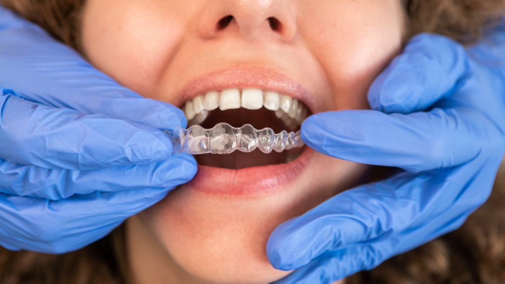 Home 39 - Professional Dental Dental professional fitting a clear Invisalign aligner onto a patient's teeth at Professional Dental in Utah.