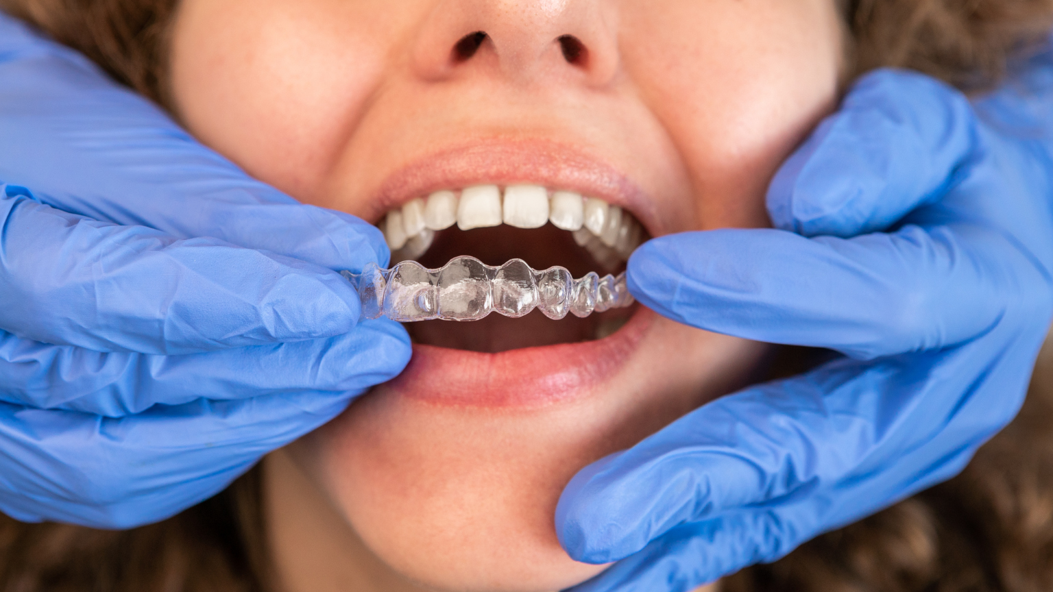 Dental professional fitting a clear Invisalign aligner onto a patient's teeth at Professional Dental in Utah.