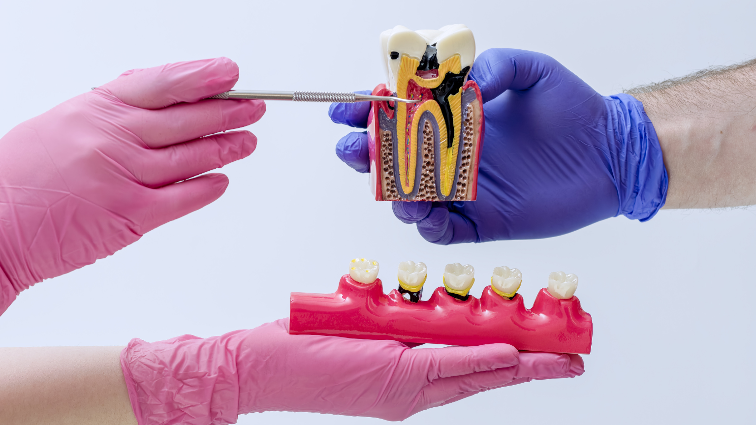 Dental specialist holding a tooth model to explain endodontics and root canal treatments at Professional Dental in Utah.