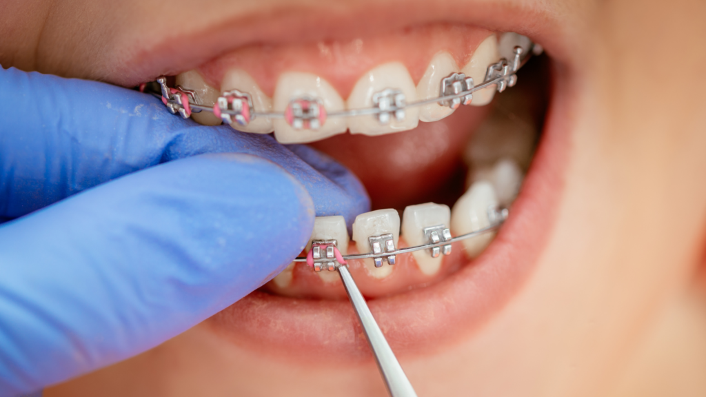 Patient smiling confidently after getting braces removed at Professional Dental in Utah